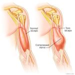 Bicipital Tendinitis: Understanding the Pain